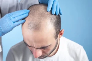 A PRP injection being prepared for a hair restoration session