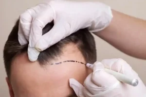 A surgeon extracts body hair follicles with precision.