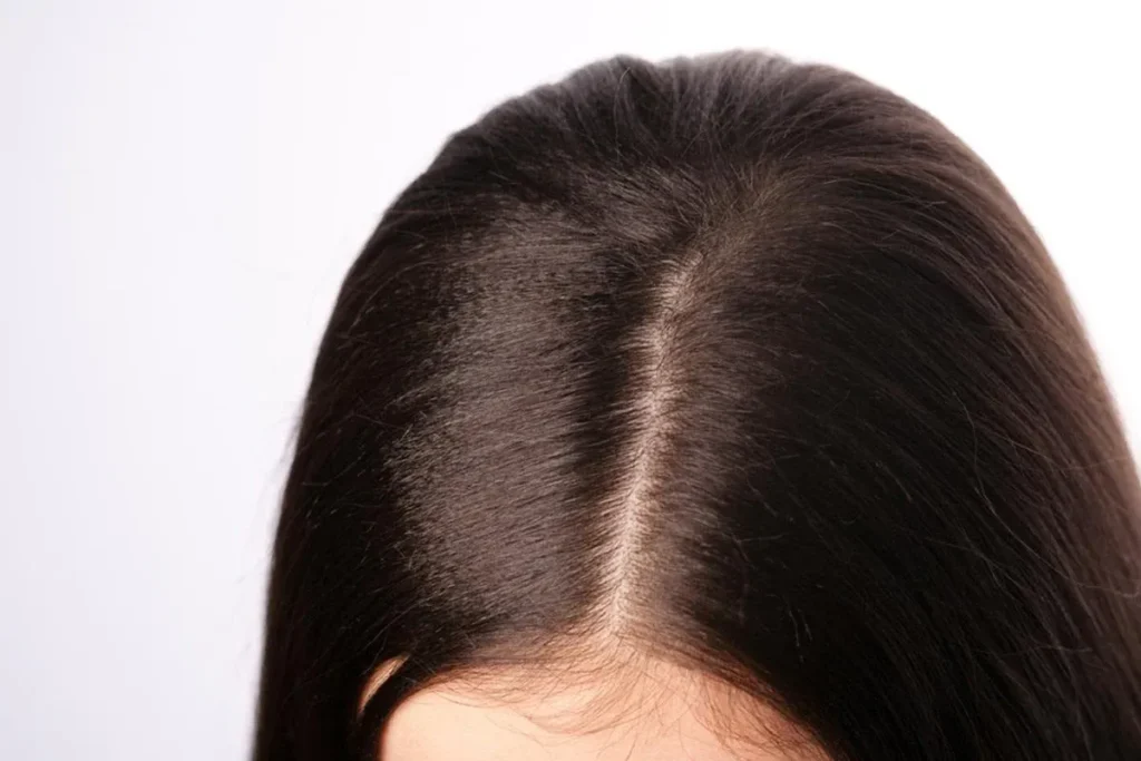 Typische mannelijke haarlijn: Krachtige tips