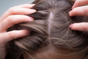 Hair loss affecting people in their 20s