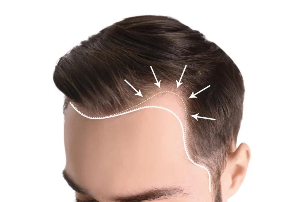 What Age Does Hairline Start Receding?