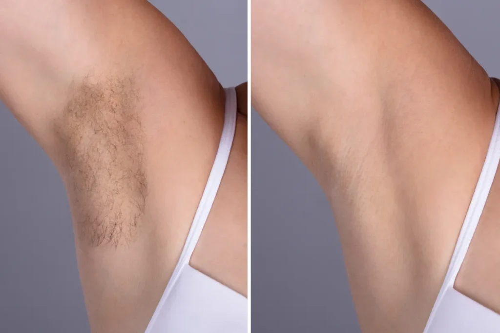 What Causes Loss Of Body Hair In Females