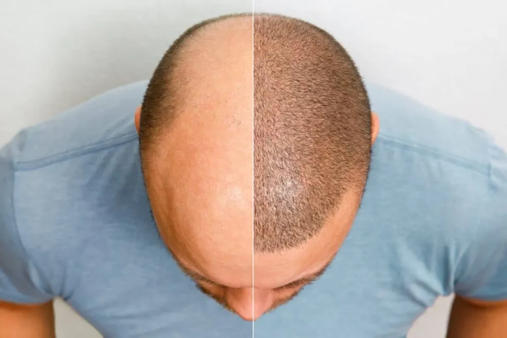 What To Expect After Hair Transplant: Fix