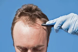 A teen noticing early signs of hair loss