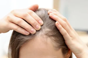 Follicular miniaturization caused by elevated DHT