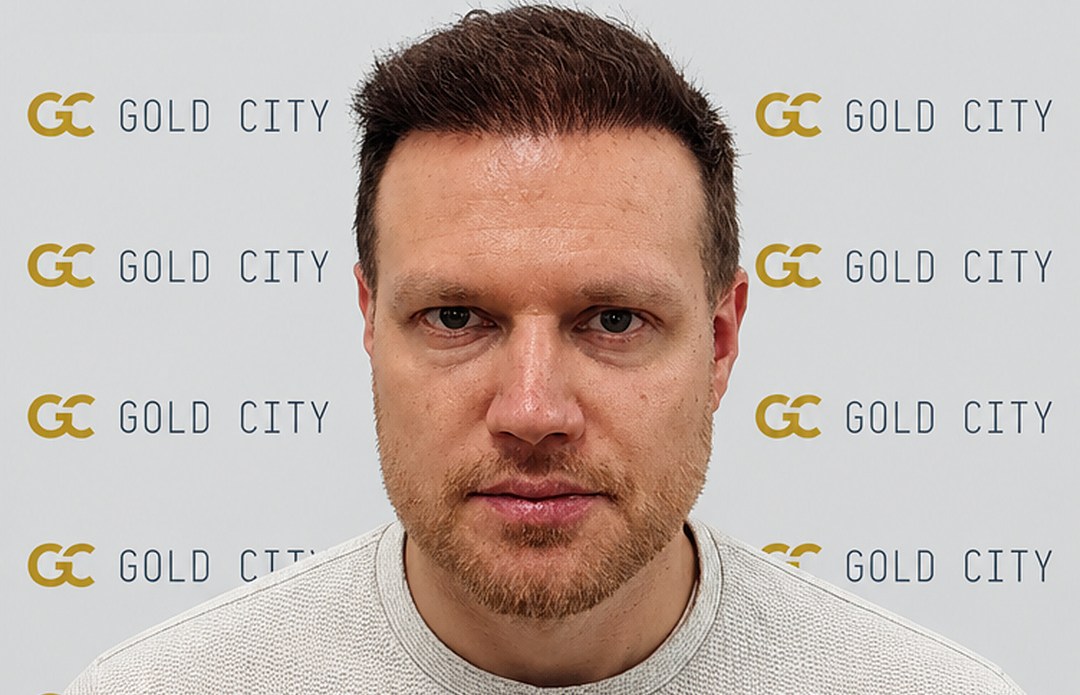 After the hair transplant at Gold City